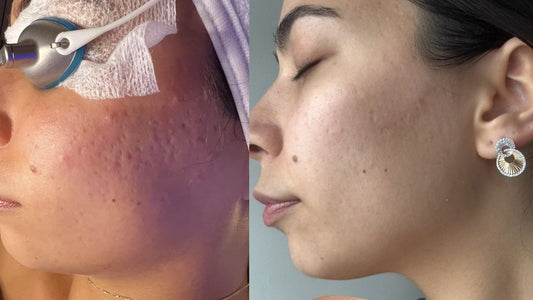 PDRN vs Traditional Microneedling | Boca Raton Skin Rejuvenation Guide