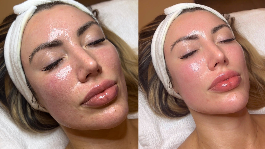VAMP™ Salmon DNA Microneedling Delray Beach | PDRN Skin Rejuvenation