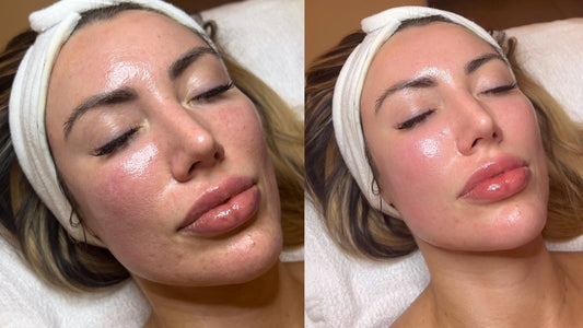 VAMP™ Salmon DNA Microneedling Delray Beach | PDRN Skin Rejuvenation