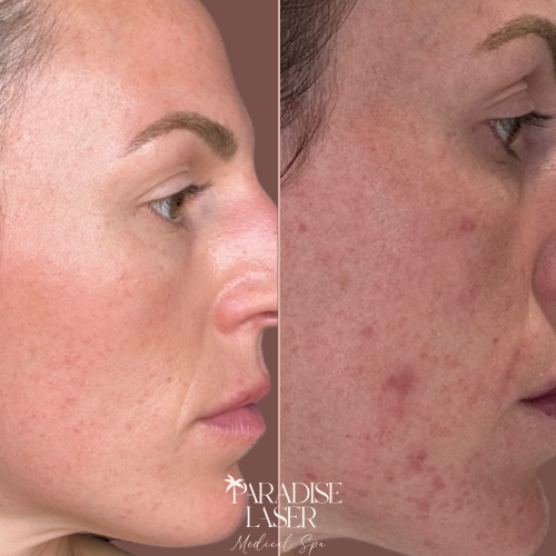Before and after microneedling treatment showing reduced acne scars, redness and improved acne - Acne scar microneedling results Delray Beach Paradise Laser Medical Spa
