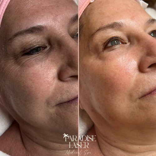 Before and after microneedling treatment showing reduced fine lines and wrinkles around eye area - Anti-wrinkle microneedling results Delray Beach Paradise Laser Medical Spa