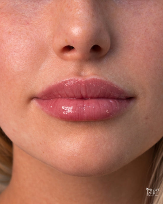 Before-and-after collage showing natural-looking lip injection results on four real patients in Delray Beach