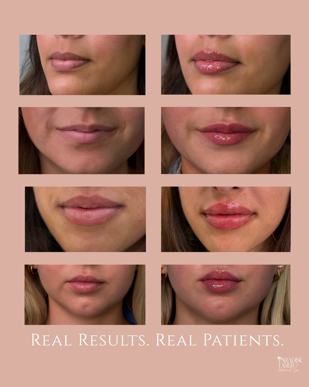 Before-and-after collage showing natural lip filler results on four real patients at Paradise Laser Medical Spa in Delray Beach