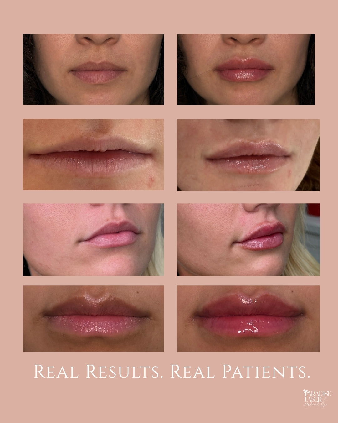 Before-and-after comparison showing natural lip filler enhancement for a patient near West Palm Beach, Florida