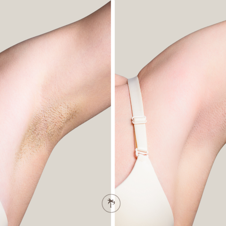 before and after laser hair removal underarm