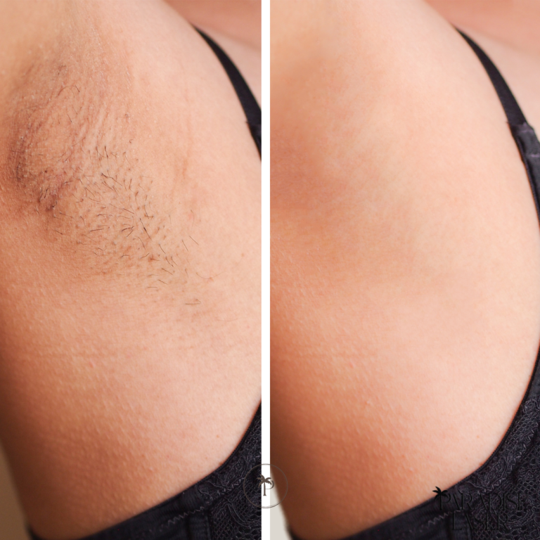 before and after laser hair removal underarms