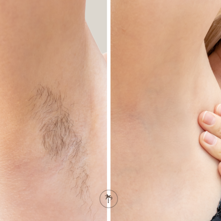 before and after laser hair removal underarms