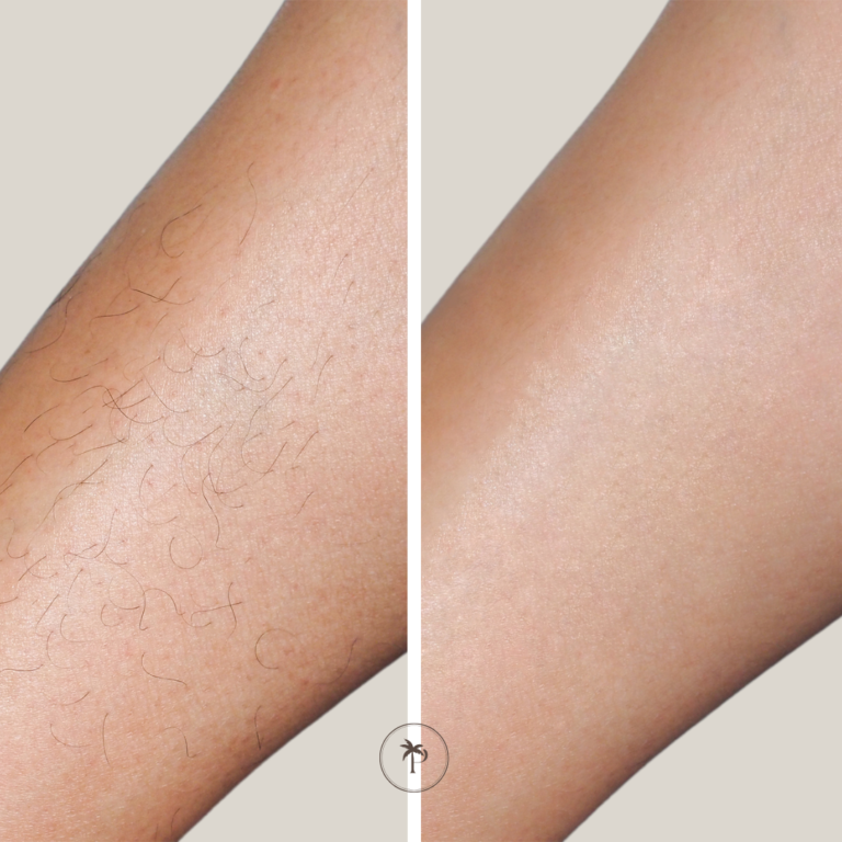 before and after laser hair removal legs