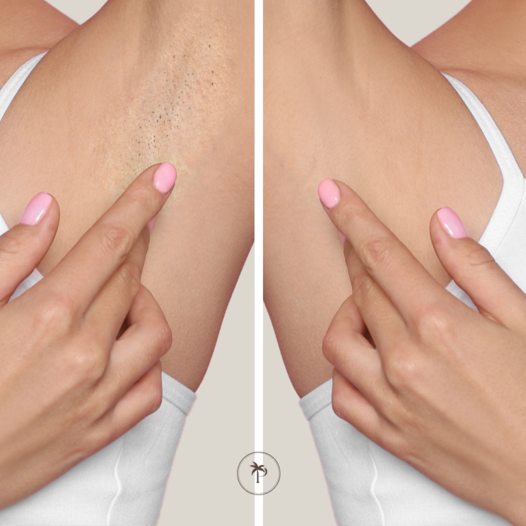 before and after laser hair removal under arms