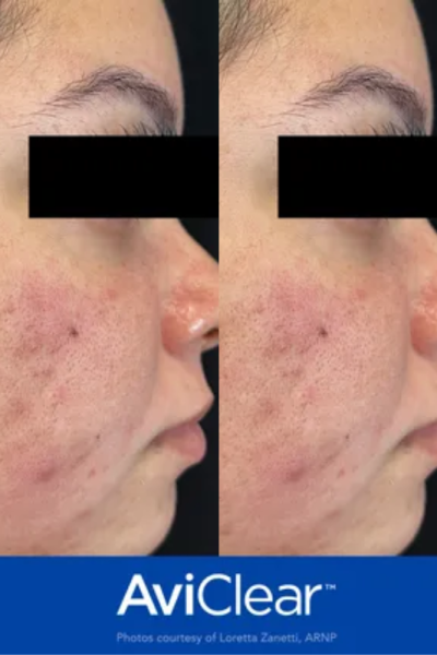 Acne before and after
